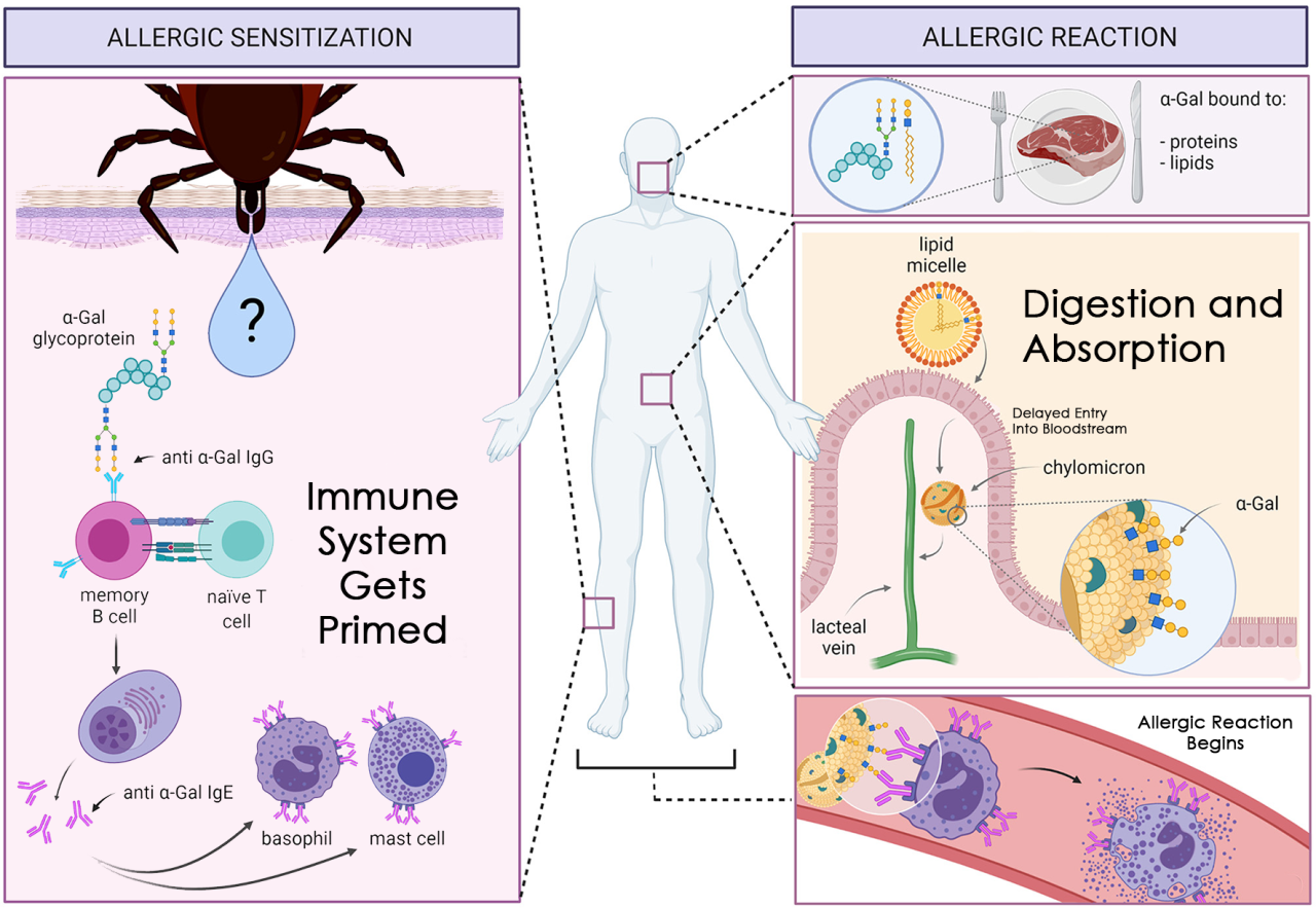 Simplified diagram showing how a tick bite can prime the immune system against alpha-gal, a sugar found in mammals. Later, when mammalian meat is eaten, alpha-gal enters the bloodstream after digestion and absorption, triggering an allergic reaction.