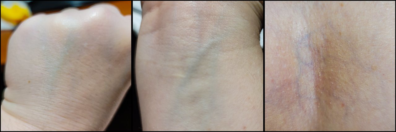 Three close-up photographs showing superficial veins visible through pale skin on the back of the hand, wrist, and inner elbow. The veins appear blue, blue-green, and purple beneath the skin.