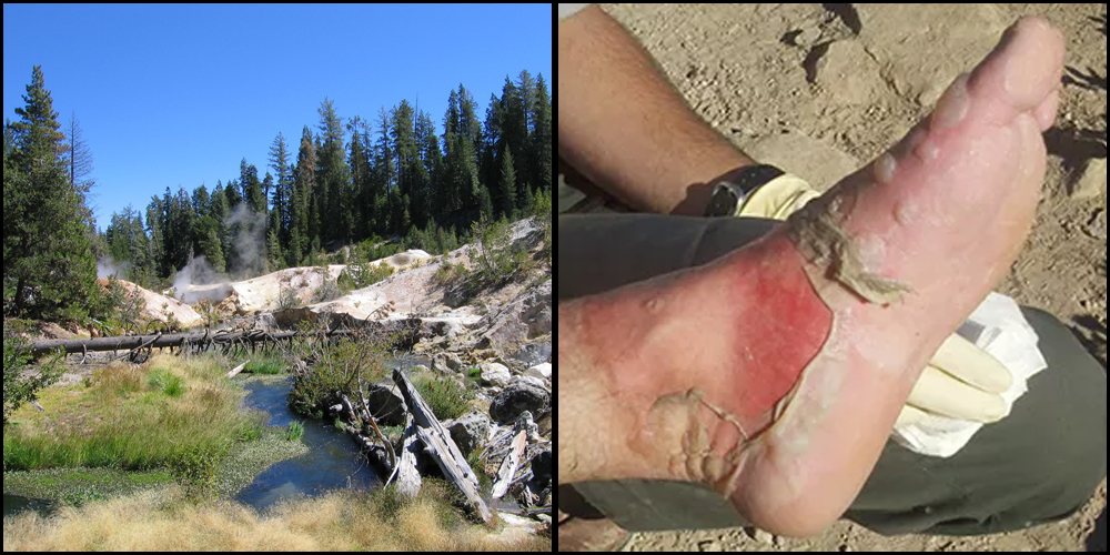 Side-by-side photographs from Devils Kitchen in Lassen Volcanic National Park. The left image shows the hydrothermal landscape with Hot Springs Creek flowing through it and steam rising in the background. The right image shows the severely burned foot of a visitor injured after traveling off-trail in the same hydrothermal area.