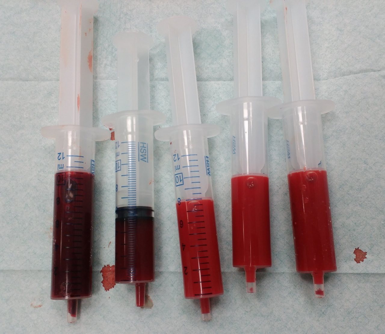 Five syringes containing human blood, showing a color difference between darker venous blood and brighter arterial blood. Both samples are red, with venous blood appearing deeper and darker.