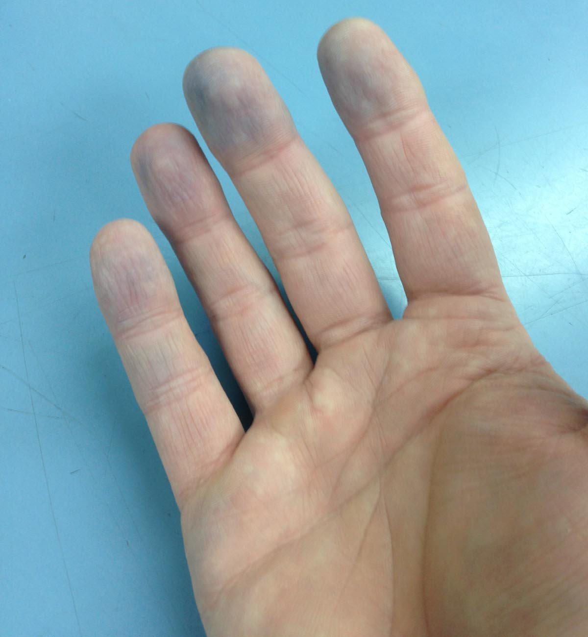Close-up photograph of a hand with bluish discoloration at several fingertips, demonstrating peripheral cyanosis associated with Raynaud’s phenomenon.